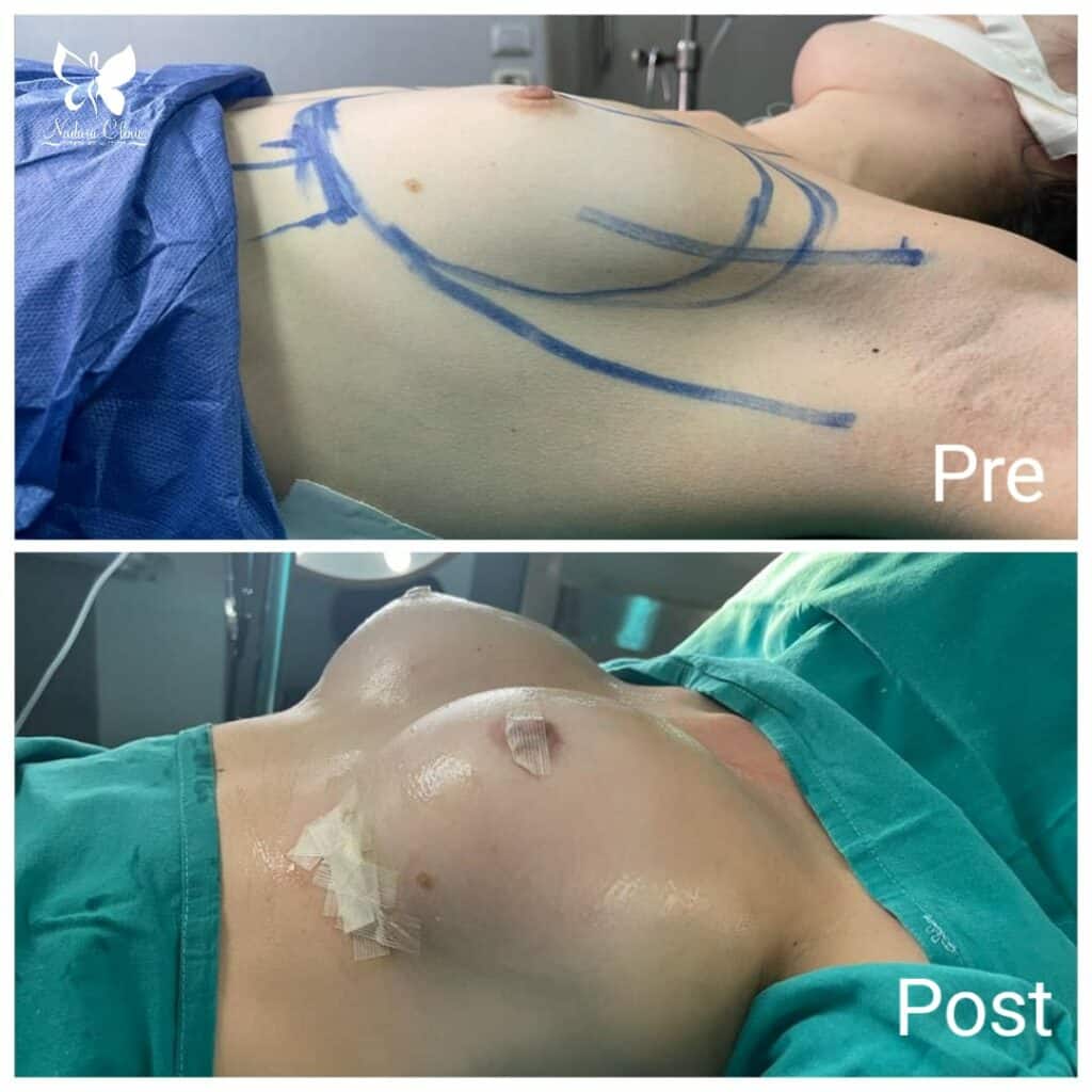 نتيجة فورية لتكبير الثدي بالسيليكون